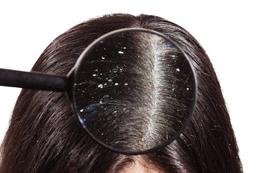 Dandruff Removal: 7 Ways to Keep Your Scalp Flake-Free